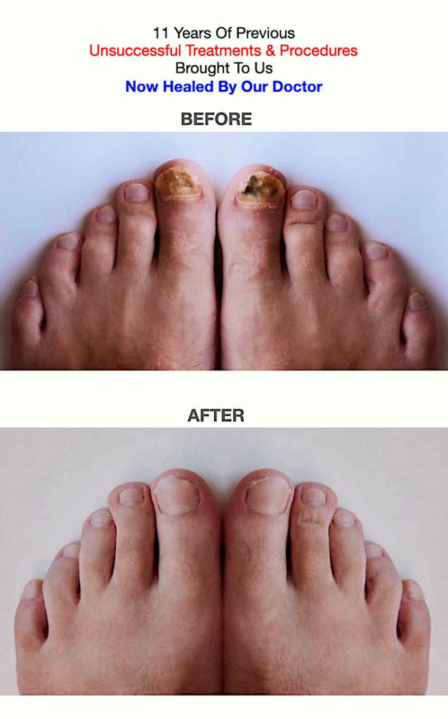 Fungus Toenail Removal